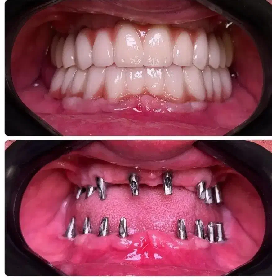 شرایط ویژه جشنواره دندانپزشکی ایمپلنت و اوردنچر|خدمات آرایشگری و زیبایی|آذرشهر, |دیوار