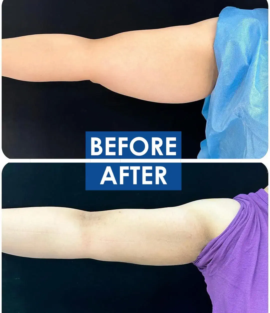 جشنواره ساکشن شکم ، پهلو و غبعب|خدمات آرایشگری و زیبایی|کرمانشاه, |دیوار