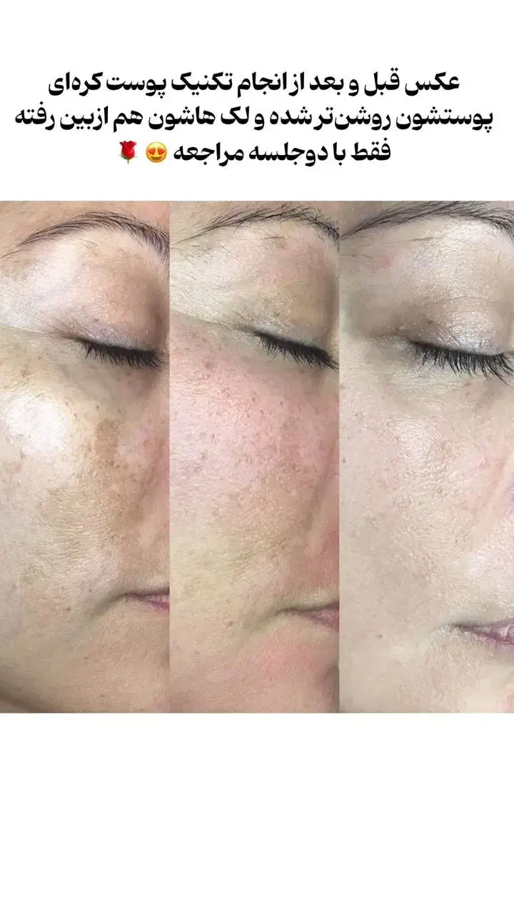 نیازمند دو مدل برای تکنیک پوست کرهای (هزینه مواد)|خدمات آرایشگری و زیبایی|ساری, |دیوار