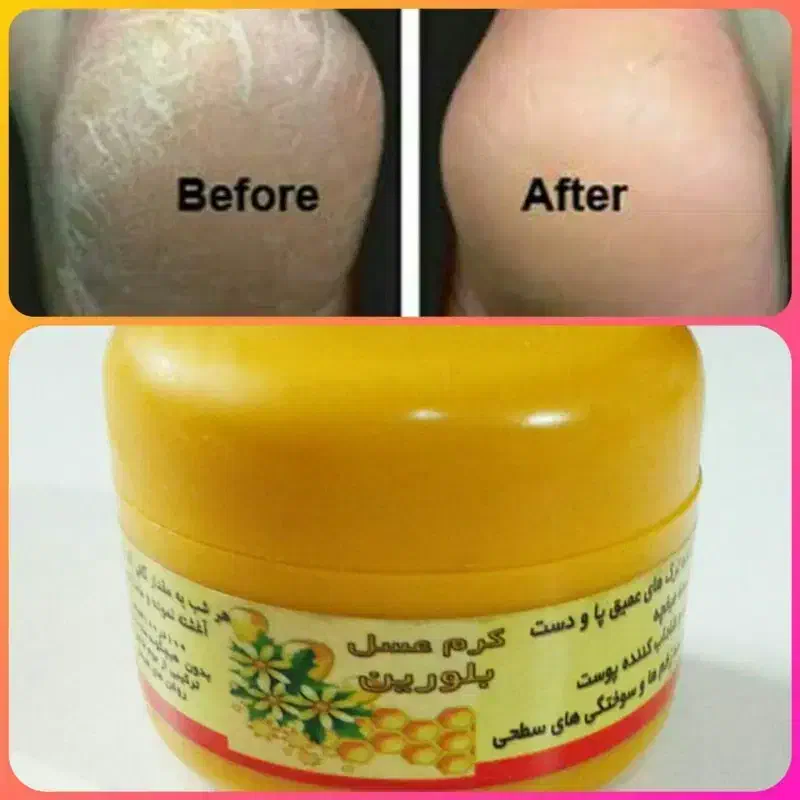 ترک پا عسل بلورین|آرایشی، بهداشتی، درمانی|لیکک, |دیوار