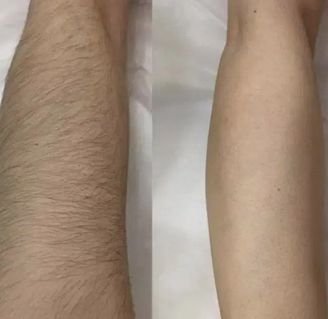 مرکز لیزر با بهترین دستگاه روز دنیا|خدمات آرایشگری و زیبایی|ایذه, |دیوار