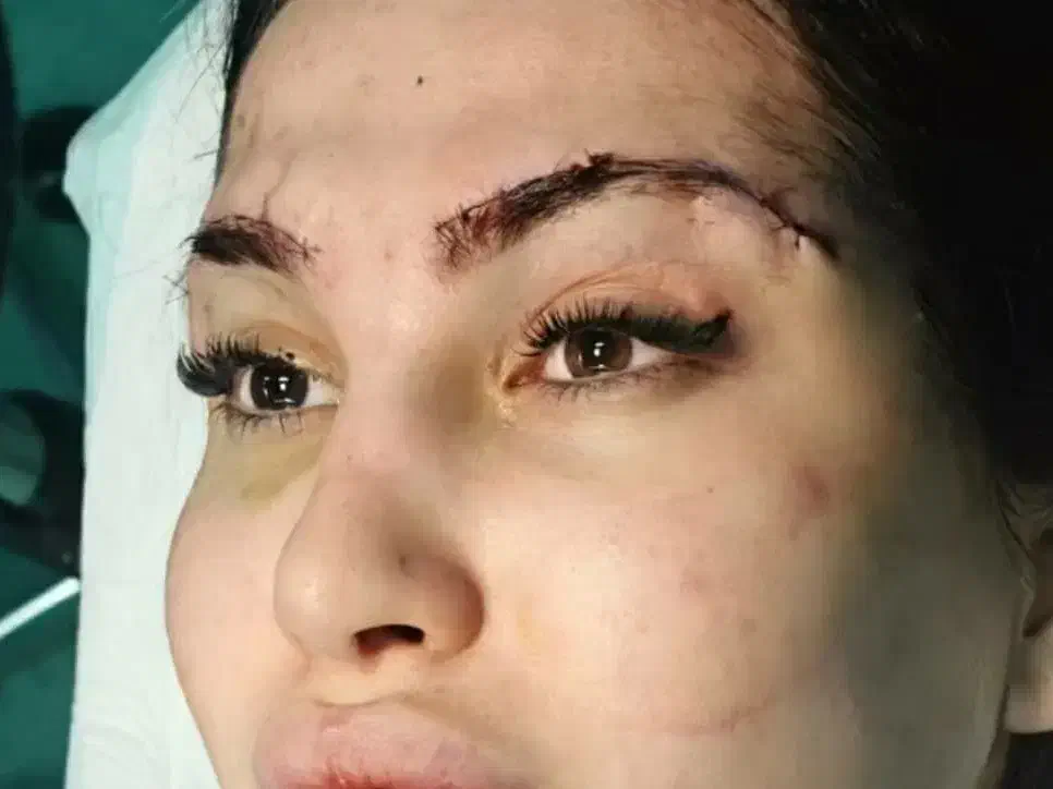 مدل بلفارو پلاستی لیفت ابرو کاشت ابرو سانترال لب|خدمات آرایشگری و زیبایی|تهران, پونک|دیوار