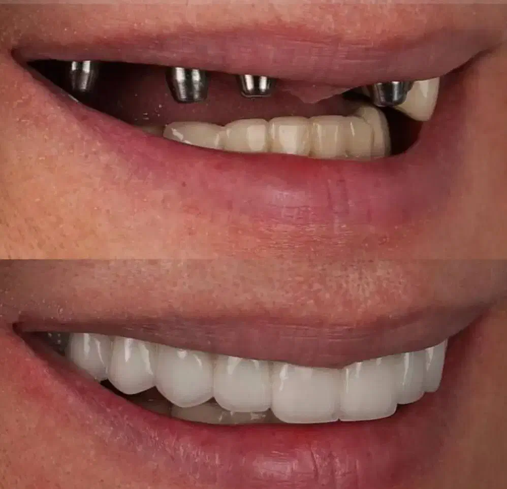 جشنواره دندانپزشکی ایمپلنت ۱۰/۳۰۰|خدمات آرایشگری و زیبایی|سلماس, |دیوار