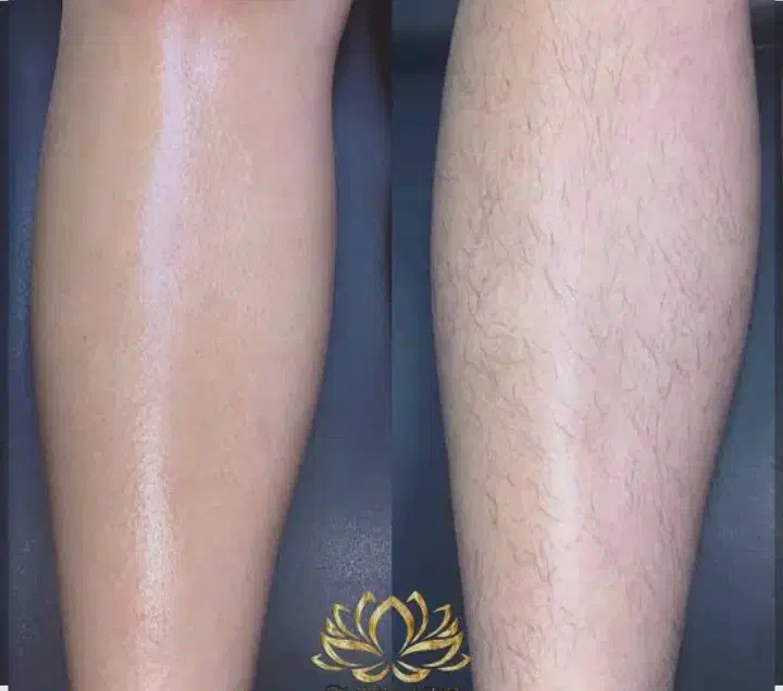 اپیلاسیون بدون درد|خدمات آرایشگری و زیبایی|سقز, |دیوار