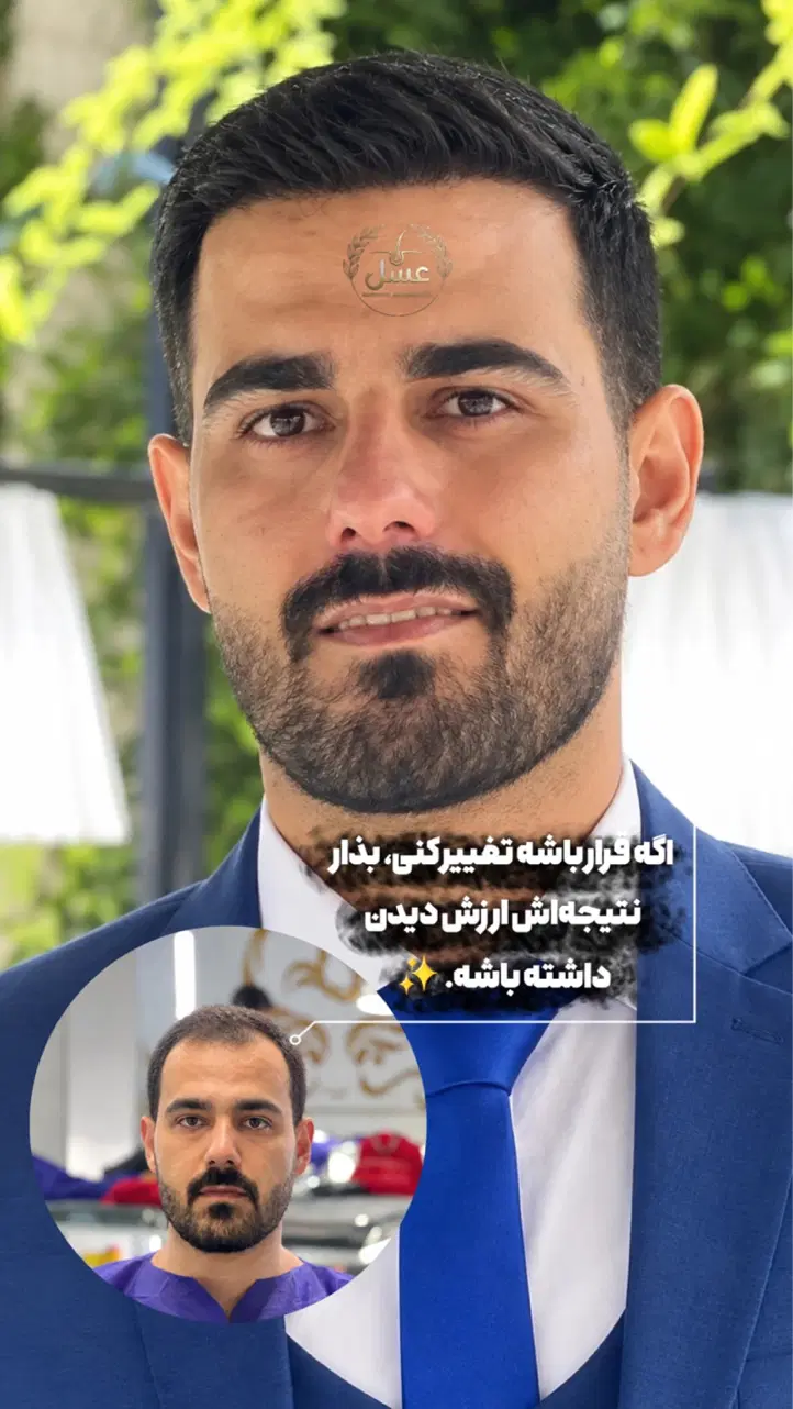 کاشت مو سوپر نچرال بدون جراحی|خدمات زیبایی و سلامت|شیراز, ستارخان|دیوار