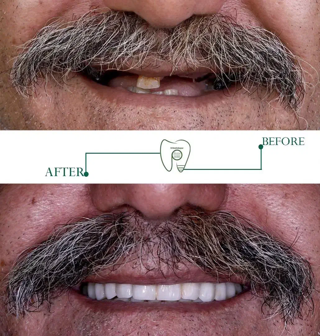 ایمپلنت دیجیتال اقساطی بدون سود تحت بیهوشی|خدمات آرایشگری و زیبایی|مرودشت, ژیان|دیوار