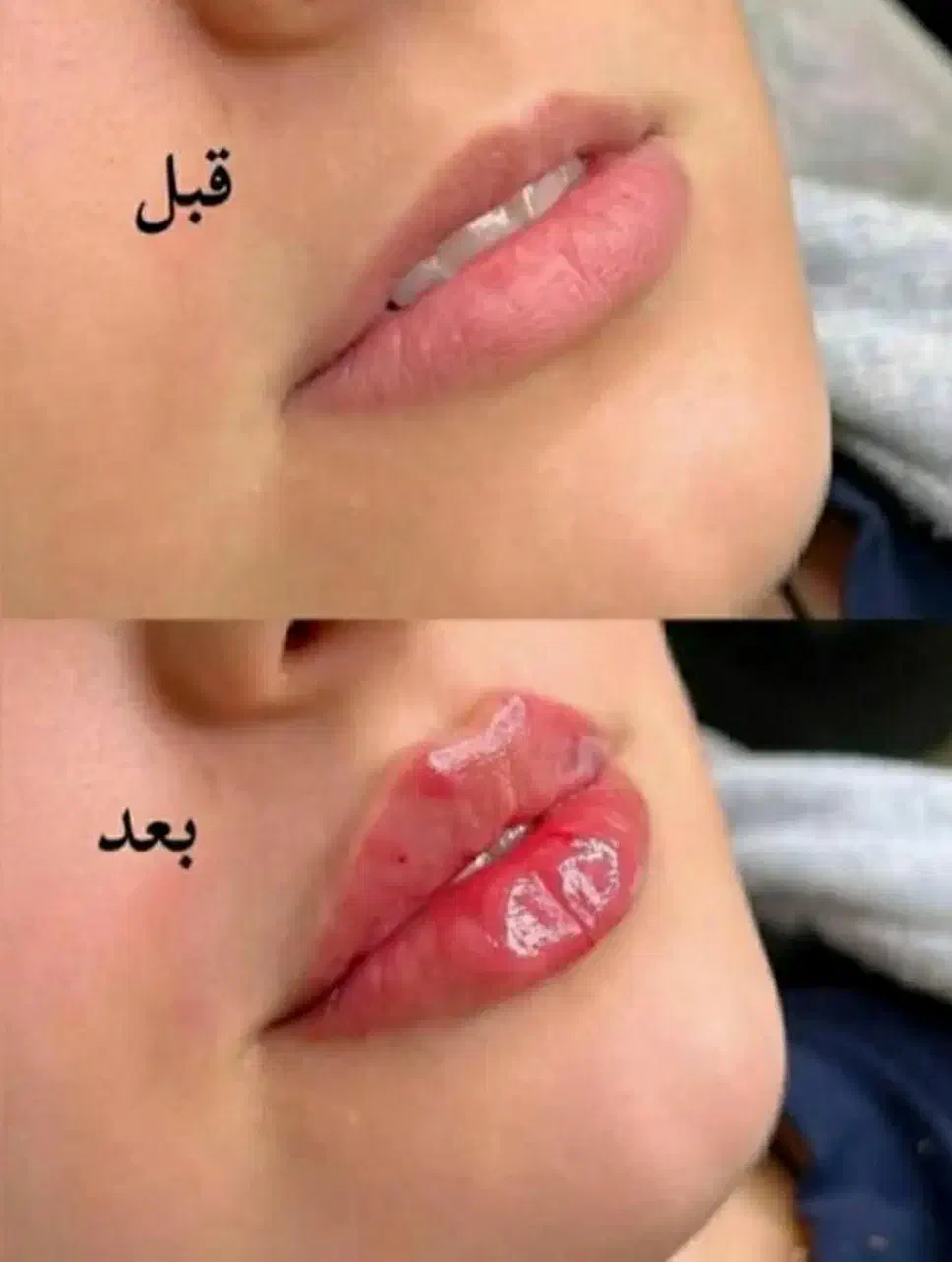 تخفیف 50 درصدی تزریق ژل و بوتاکس|خدمات آرایشگری و زیبایی|ارومیه, |دیوار