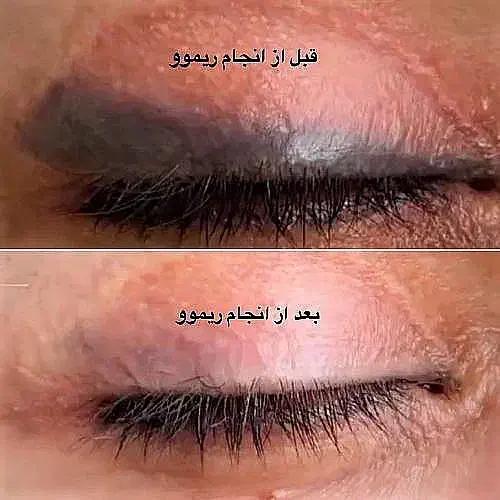 مدل پاک کردن تتو های چالشی صورت|خدمات آرایشگری و زیبایی|خمینی‌شهر, |دیوار