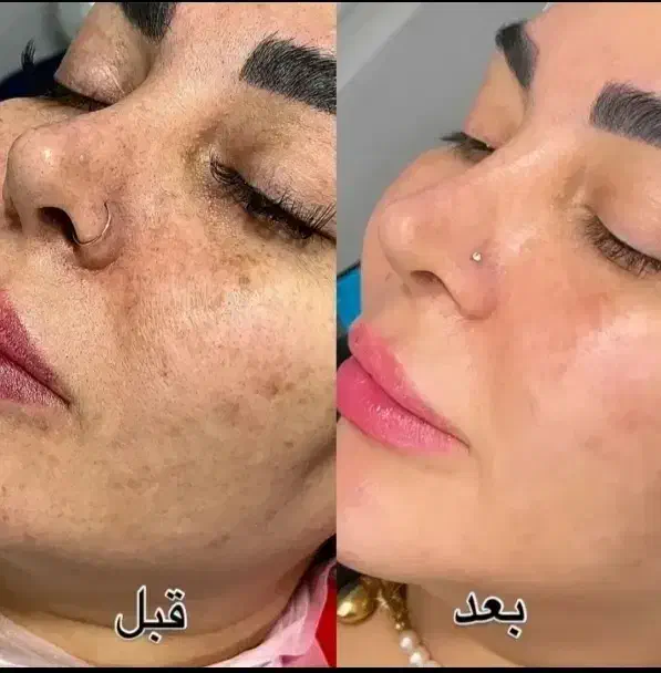 جشنوار یلدا درمان تضمینی کک ومک/لک/خال/فقط در1جلسه|خدمات آرایشگری و زیبایی|اصفهان, باغ زیار|دیوار