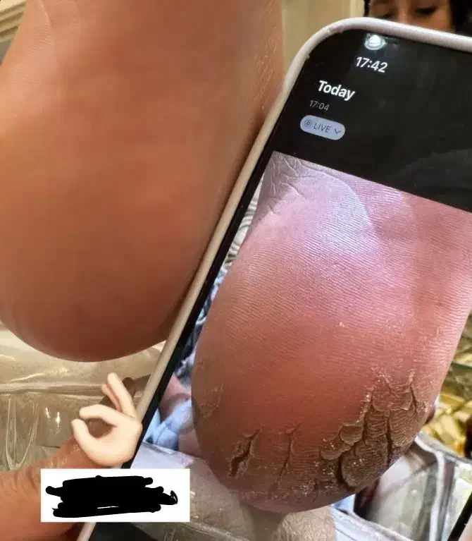 درمان خشکی و ترک کف پا درمانی با دستگاه|خدمات آرایشگری و زیبایی|تربت‌حیدریه, نواب صفوی|دیوار