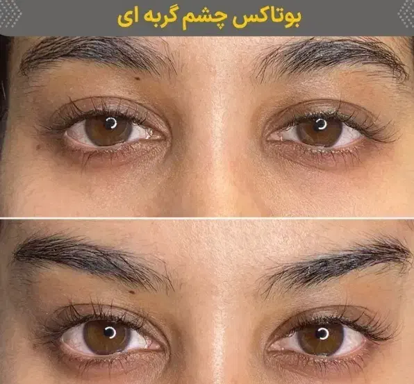 تزریق ژل و بوتاکس|خدمات آرایشگری و زیبایی|دوگنبدان, |دیوار