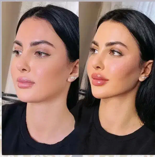 ژل ،فیلر و بوتاکس|خدمات آرایشگری و زیبایی|صفادشت, |دیوار