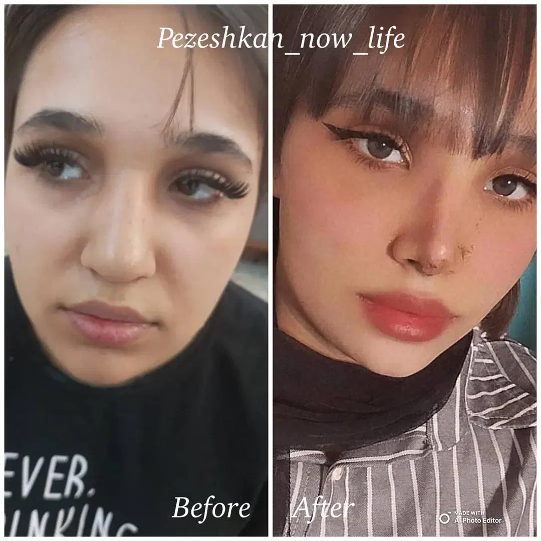 جشنواره عمل بینی فقط (۳۵) توسط متخصص|خدمات آرایشگری و زیبایی|شاهین‌شهر, فردوسی|دیوار