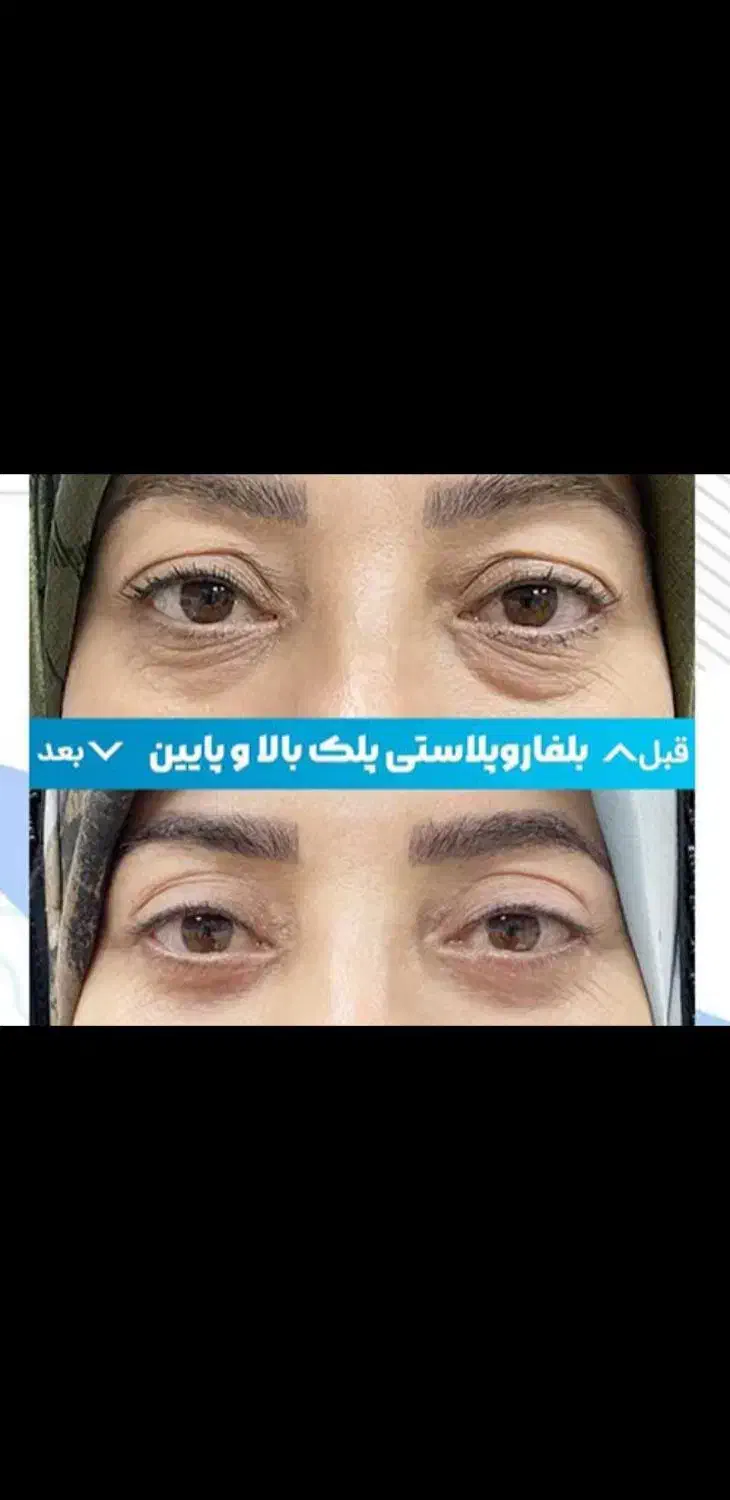 عمل زیبائی پلک پائین شامل پف ، چروک و...|خدمات آرایشگری و زیبایی|اصفهان, خلجا|دیوار
