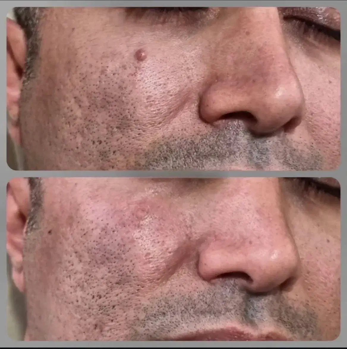 حذف خال و زگیل و رفع جای جوش و حفرات با تخفیف|خدمات آرایشگری و زیبایی|تهران, بیسیم|دیوار