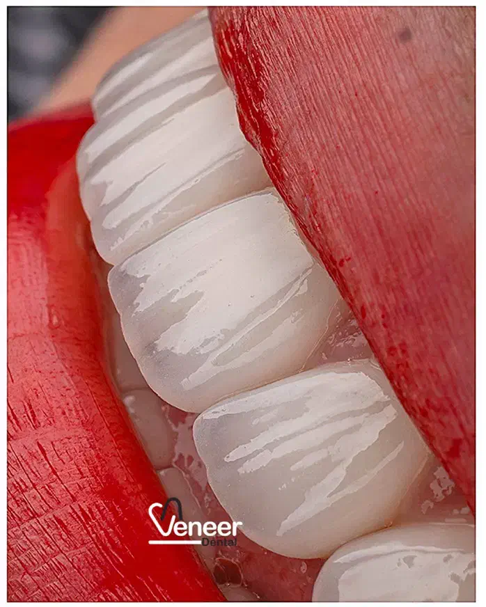 دندانپزشکی کامپوزیت ایمپلنت لمینت (بدون تراش)|خدمات آرایشگری و زیبایی|تهران, زعفرانیه|دیوار