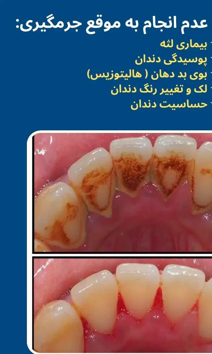 جرم گیری دندان با تعرفه دولتی تحت پوشش بیمه|آرایشی، بهداشتی، درمانی|اصفهان, دهنو|دیوار