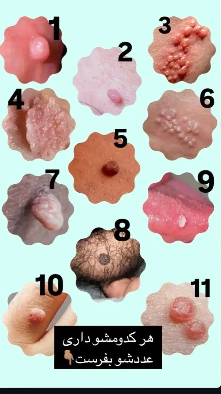 ازبین برندن زگیل تناسلی درکمتراز۱۵روزوبهبودی کامل|خدمات آرایشگری و زیبایی|گرگان, |دیوار