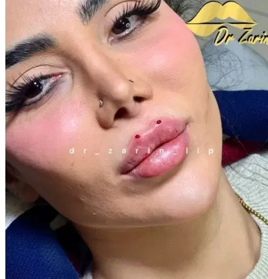 فیلربینی بوتاکس نخ ابرو لب روسیMزاویه ژل گونه پزشک|خدمات آرایشگری و زیبایی|تهران, الهیه|دیوار