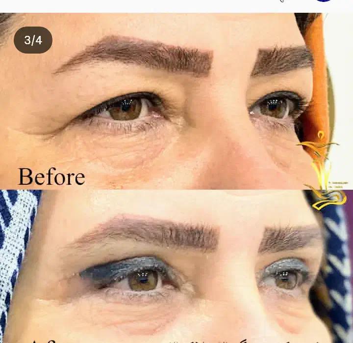 ۴۰٪آف۲۰روزه/غبغب/جراح پلاستیک/دستگاه۲۰۲۵پال آمریکا|خدمات آرایشگری و زیبایی|مشهد, کوه سنگی|دیوار