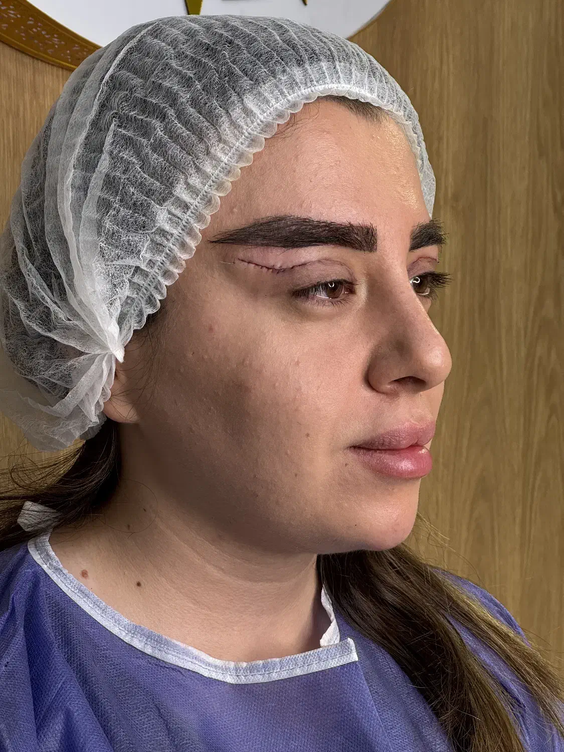 بلفاروپلاستی تضمینی تزریق فیلر بوتاکس و لیزر اقساط|خدمات آرایشگری و زیبایی|تبریز, |دیوار