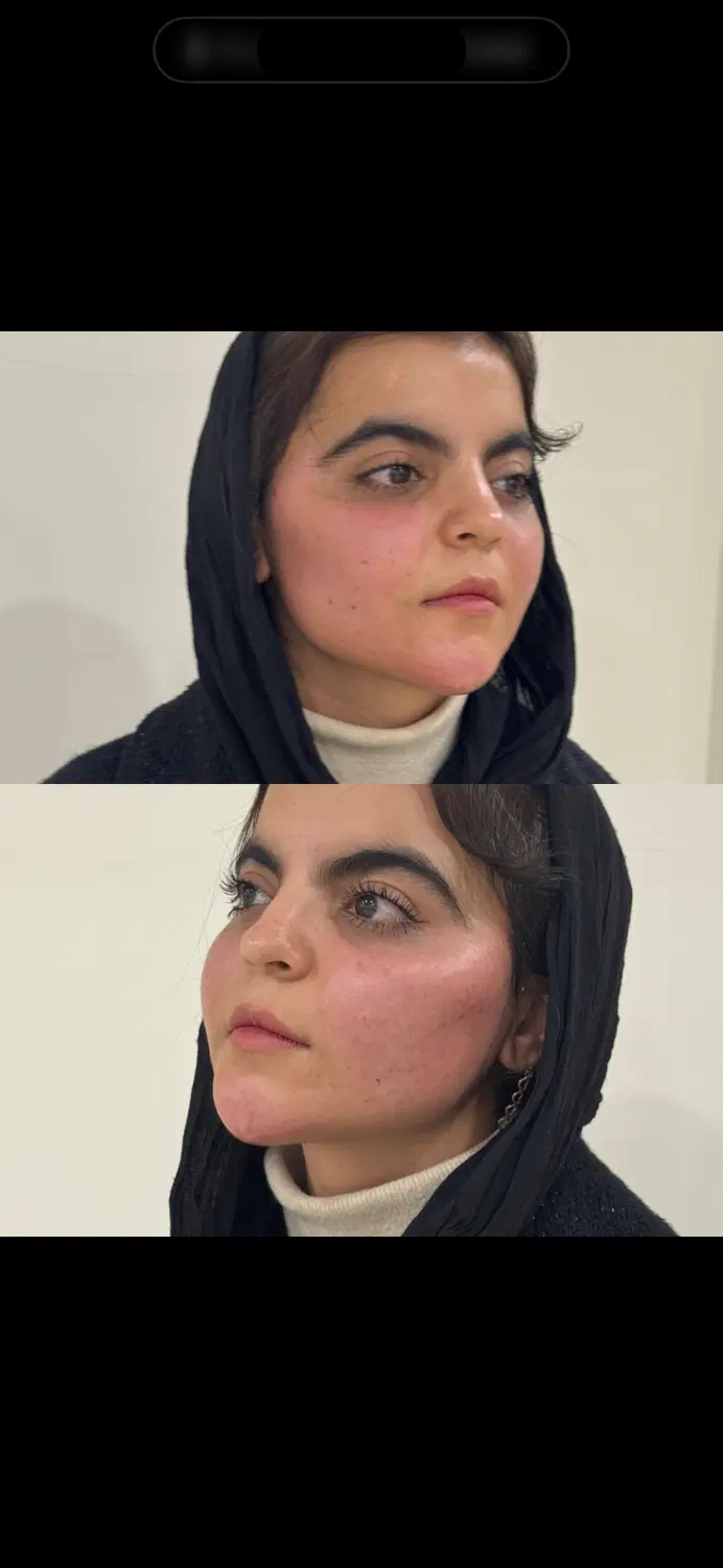 مدل جهت تزریق چربی/انجام بلفاروپلاستی|خدمات زیبایی و سلامت|تهران, شکوفه (عبدل آباد)|دیوار