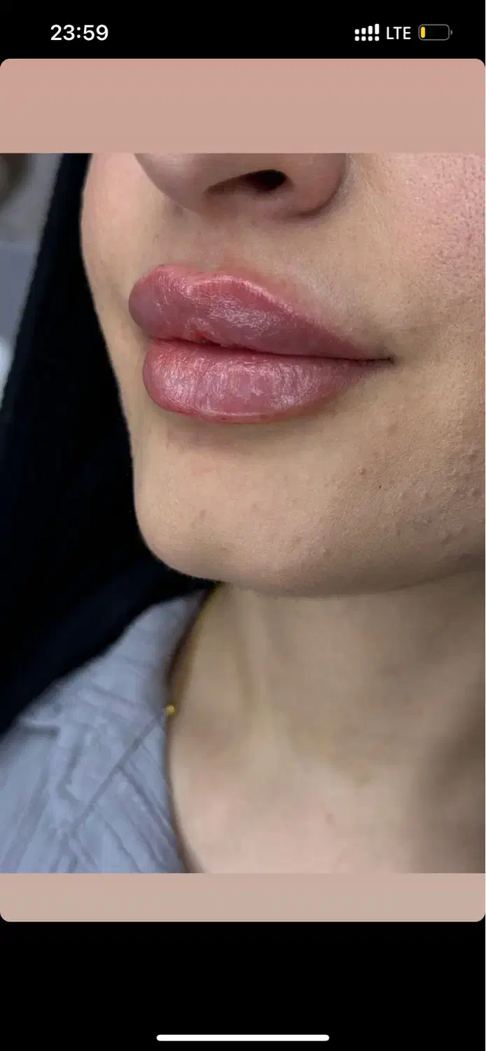 ژل بوتاکس ژل لب فیلرزیر چشم مزوتراپی مزوژل|خدمات آرایشگری و زیبایی|شیراز, کاراندیش|دیوار