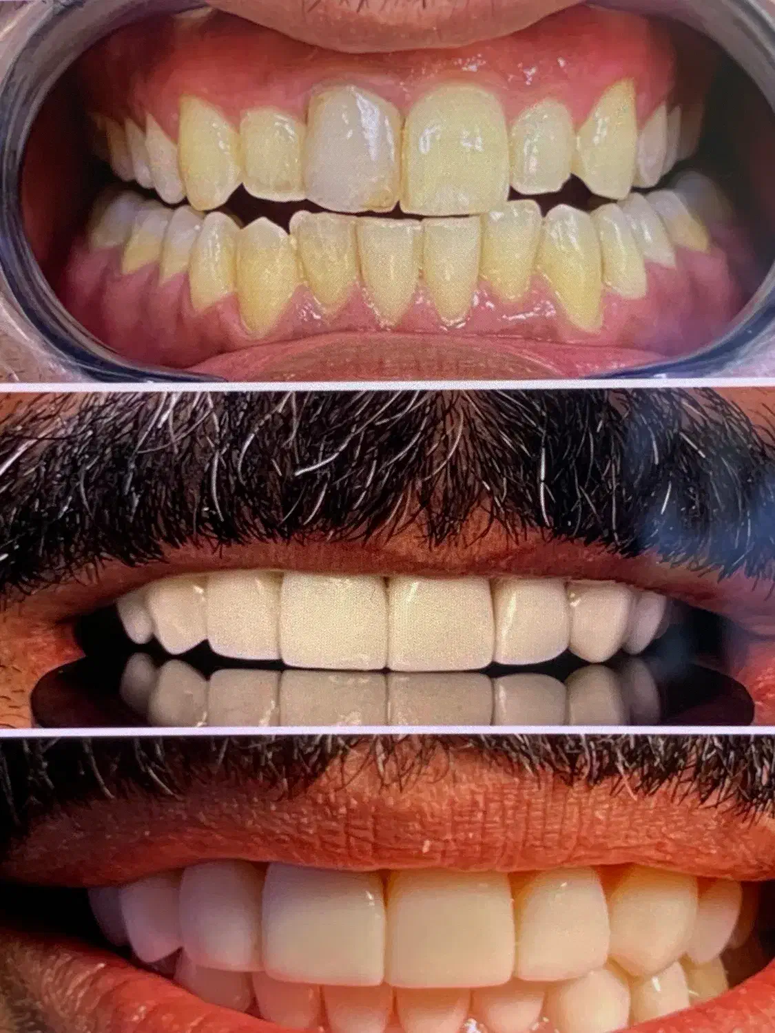 ایمپلنت ارتودنسی لمینت کامپوزیت|خدمات آرایشگری و زیبایی|مشهد, دوست آباد|دیوار