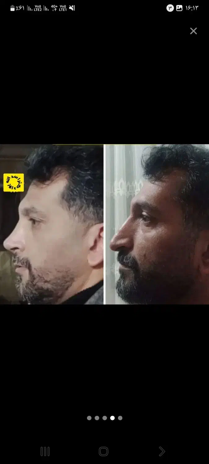 جشنواره تخفیف عمل زیبایی بینی|خدمات آرایشگری و زیبایی|قائم‌شهر, |دیوار