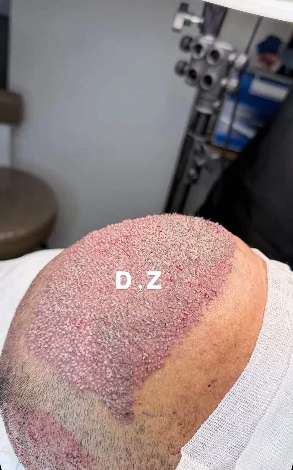 کاشت مو فول تراکم شیرازی در ساری|خدمات آرایشگری و زیبایی|ساری, |دیوار