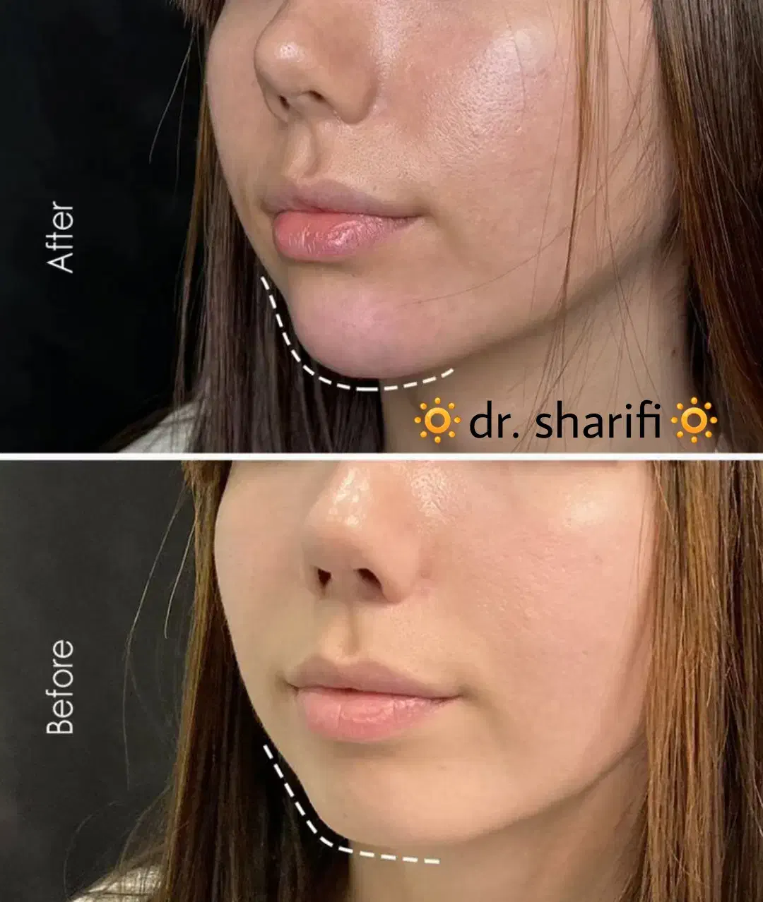 جشنواره ژل بوتاکس فیلر در مرکز زیبایی دکتر شریفی|خدمات آرایشگری و زیبایی|قم, بلوار امین و ساحلی|دیوار