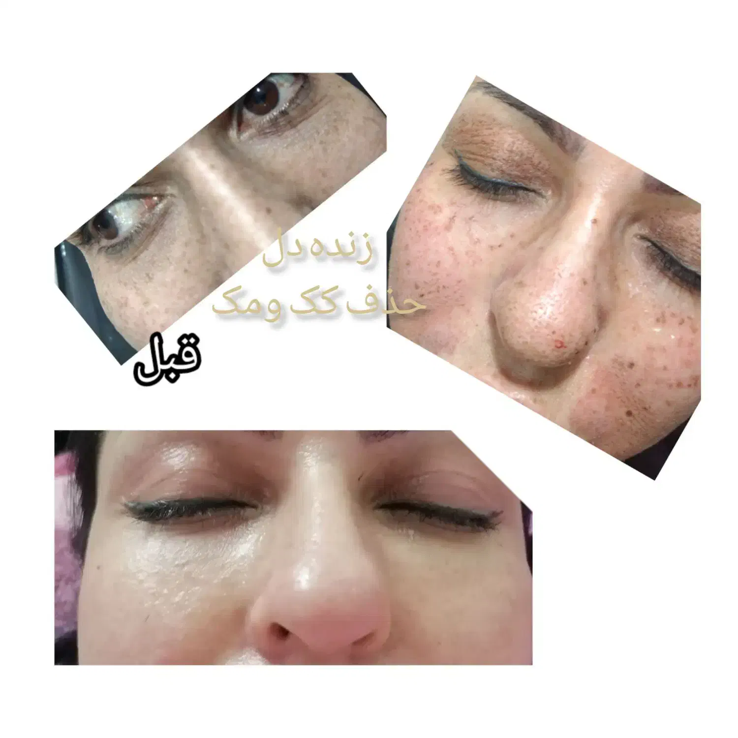 پلکسر پلاسما خالبرداری مزونیدلینگ مزو آموزش|خدمات آرایشگری و زیبایی|زاهدان, |دیوار