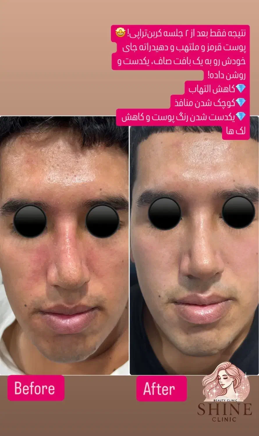 روشن سازی با لیزر پیکوشور و پاک کردن تتو|خدمات آرایشگری و زیبایی|هندیجان, |دیوار