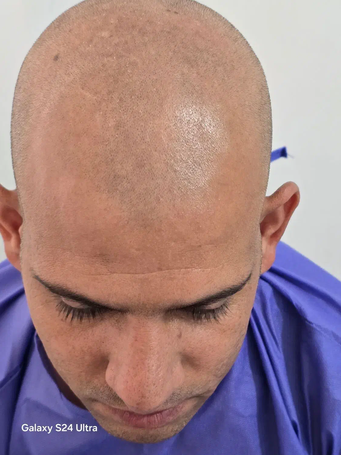 مرکز تخصصی کاشت موی طبیعی رویش طلایی مکران|خدمات آرایشگری و زیبایی|چابهار, |دیوار