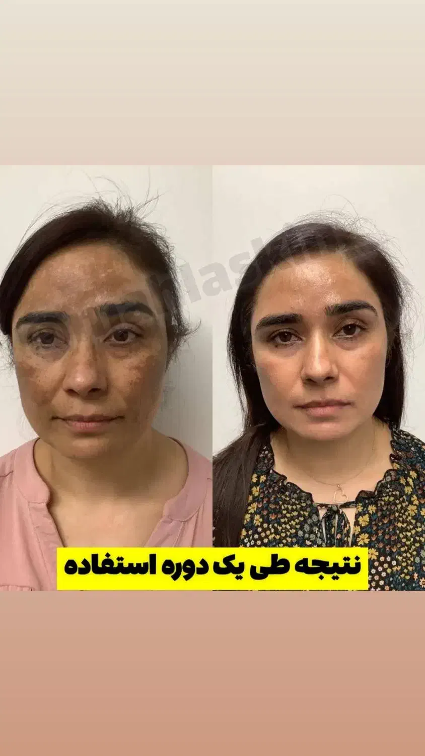 لک و تیرگی|آرایشی، بهداشتی، درمانی|گوهرکوه, |دیوار