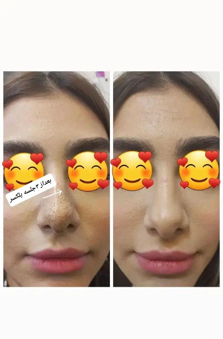 فیشیال (پاکسازی) خالبرداری و پلاسما صورت|خدمات آرایشگری و زیبایی|کوهدشت, |دیوار