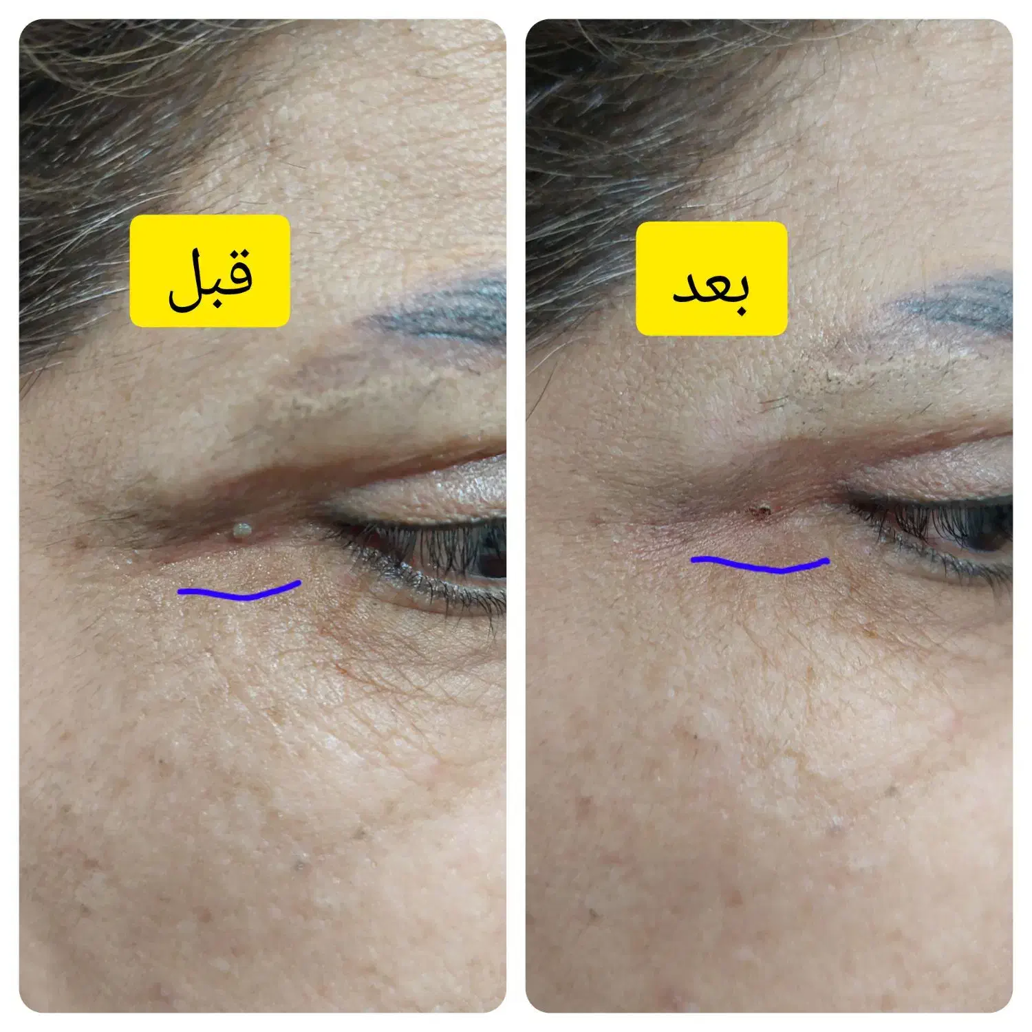 برداشتن خال و انواع ضایعه پوستی|خدمات آرایشگری و زیبایی|گرگان, |دیوار