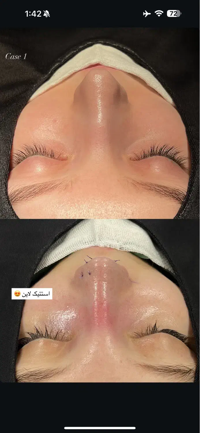 جشنواره عمل بینی به سبک جراحان ترکیه|خدمات آرایشگری و زیبایی|لامرد, |دیوار