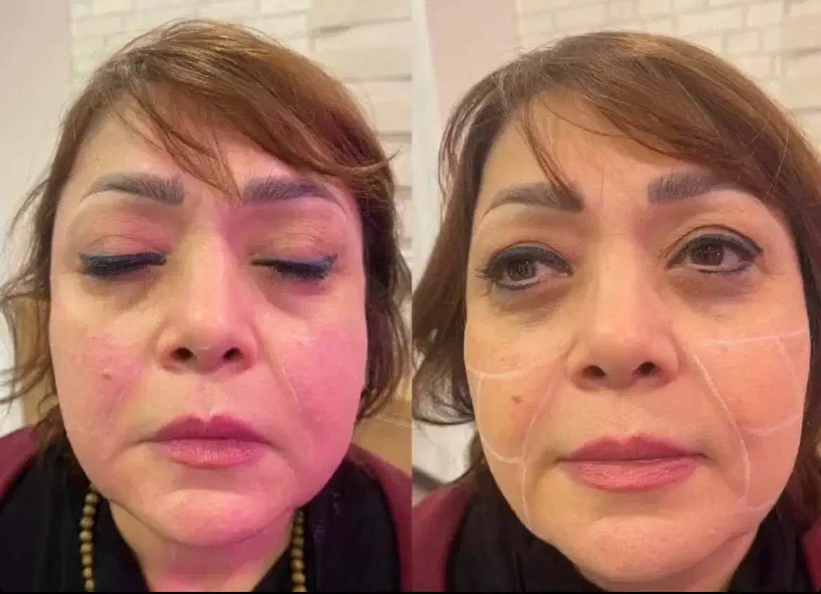 هایفو و جوانسازی صورت باتخفیف باور نکردنی|خدمات آرایشگری و زیبایی|قائمشهر, |دیوار