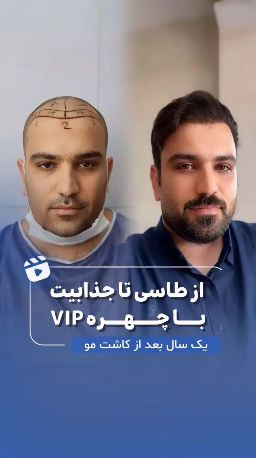 کاشت مو در یکروز|خدمات آرایشگری و زیبایی|تهران, گاندی|دیوار