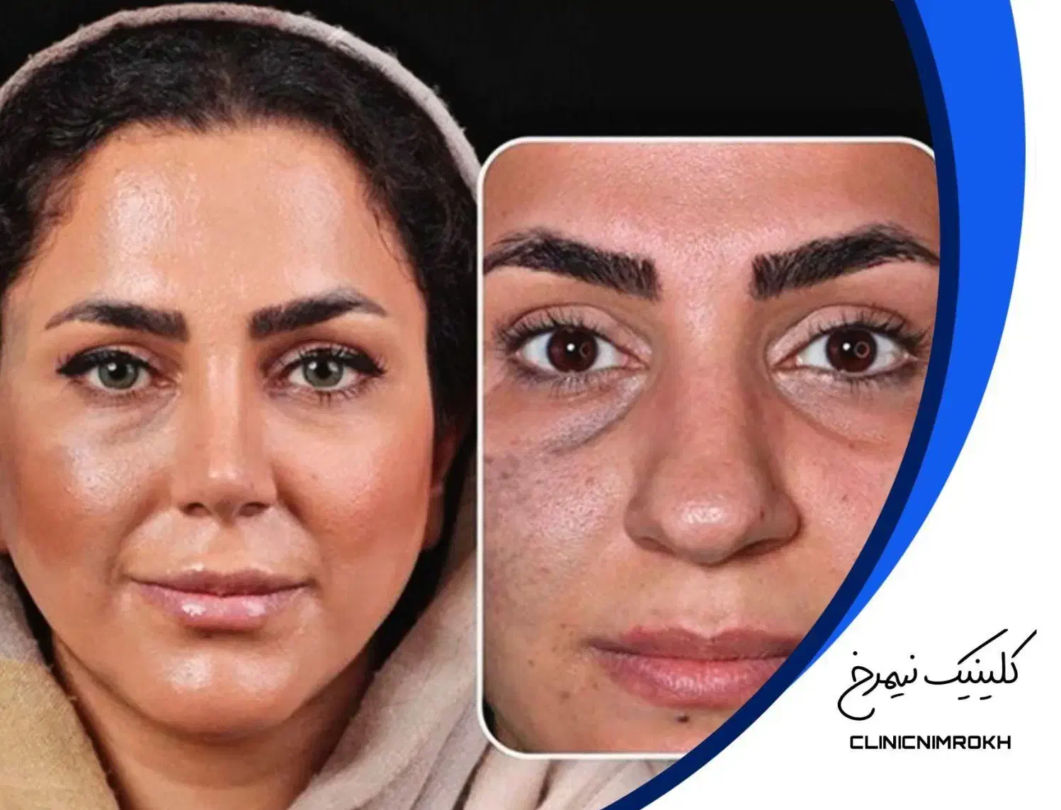 آخرین مهلت عمل بینی|خدمات آرایشگری و زیبایی|تهران, نظامی گنجوی (توانیر)|دیوار
