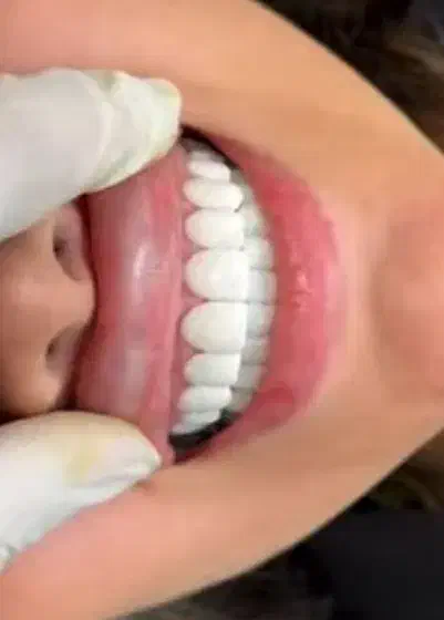 کامپوزیت دندان بابل|خدمات آرایشگری و زیبایی|امیرکلا, |دیوار