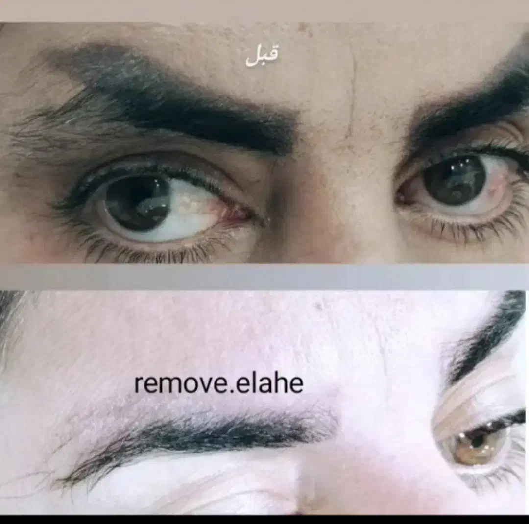 ریموو تک جلسه ای تضمینی|خدمات آرایشگری و زیبایی|مهران (ایلام), |دیوار