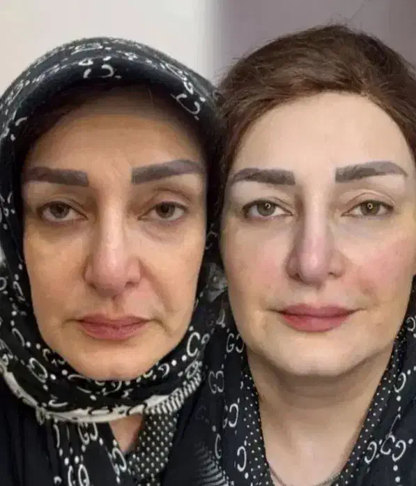 تخفیف کلینیک ژل بوتاکس نخ|خدمات آرایشگری و زیبایی|یاسوج, |دیوار