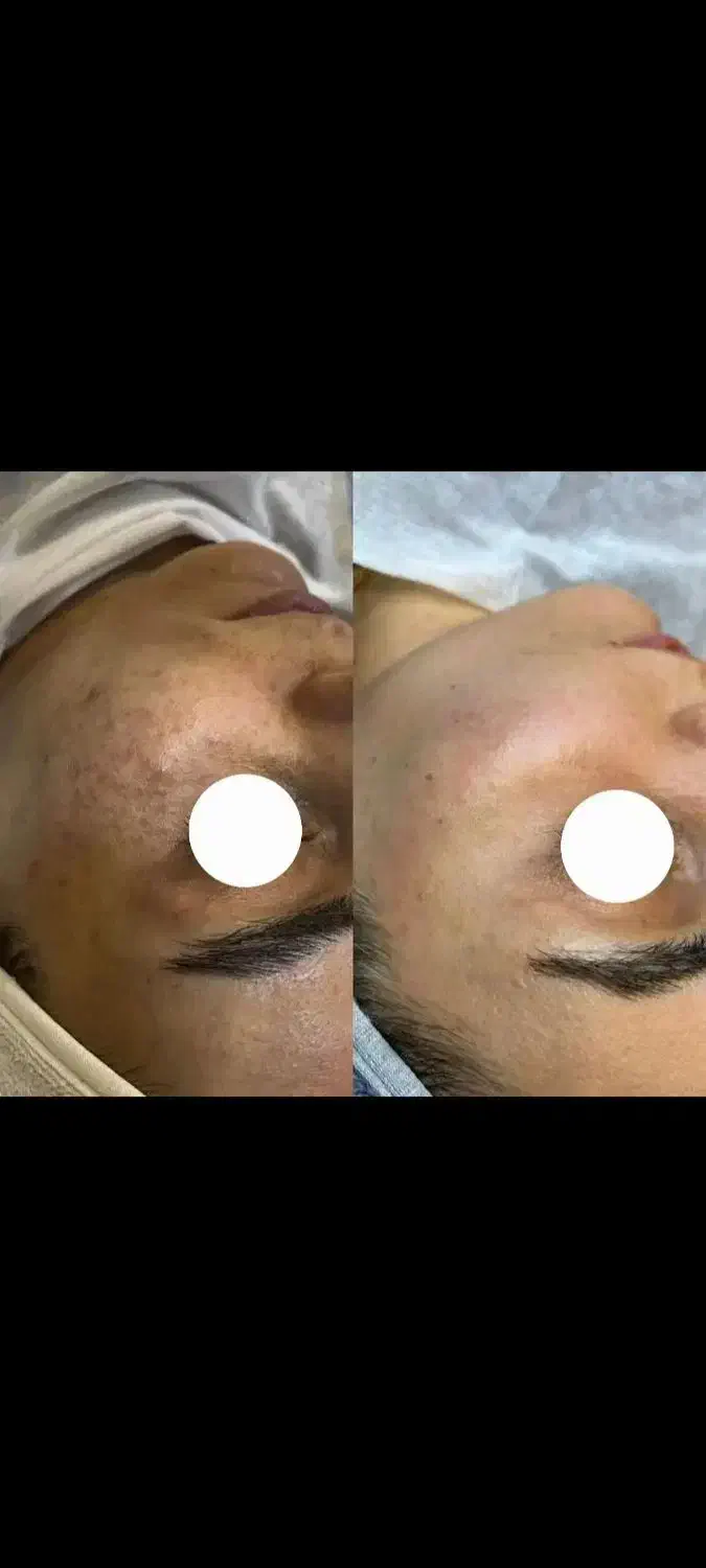 جوانسازی ،درمان پوست ،فیشال،پاکسازی،پوست کره ای|خدمات آرایشگری و زیبایی|شیراز, قدوسی غربی|دیوار