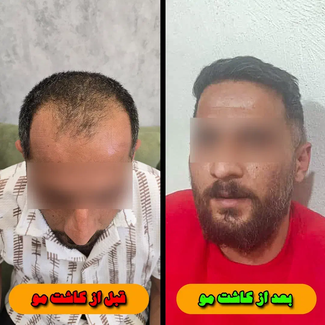 جشنواره یلدایی کاشت تخصصی مو و ابرو (شرایط اقساط)|خدمات آرایشگری و زیبایی|شیراز, خلدبرین|دیوار