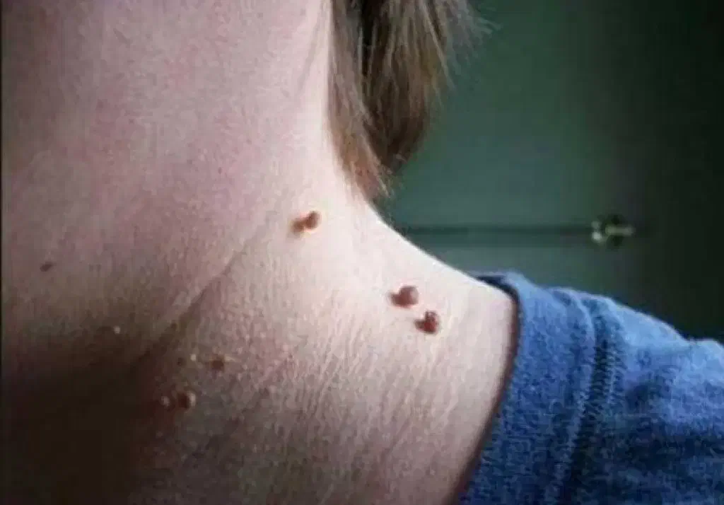 دستگاه خال برداری وزگیل برداری حتی جا های حساس|آرایشی، بهداشتی، درمانی|آبادان, |دیوار