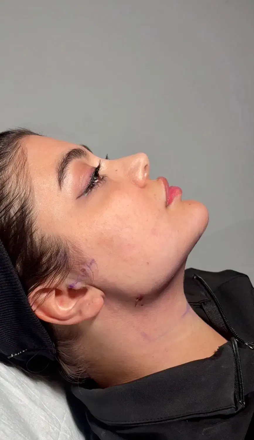 وی لاین تکنیک انحصاری کیلینیک مهرزاد ساکشن غبغب|خدمات آرایشگری و زیبایی|تهران, الهیه|دیوار