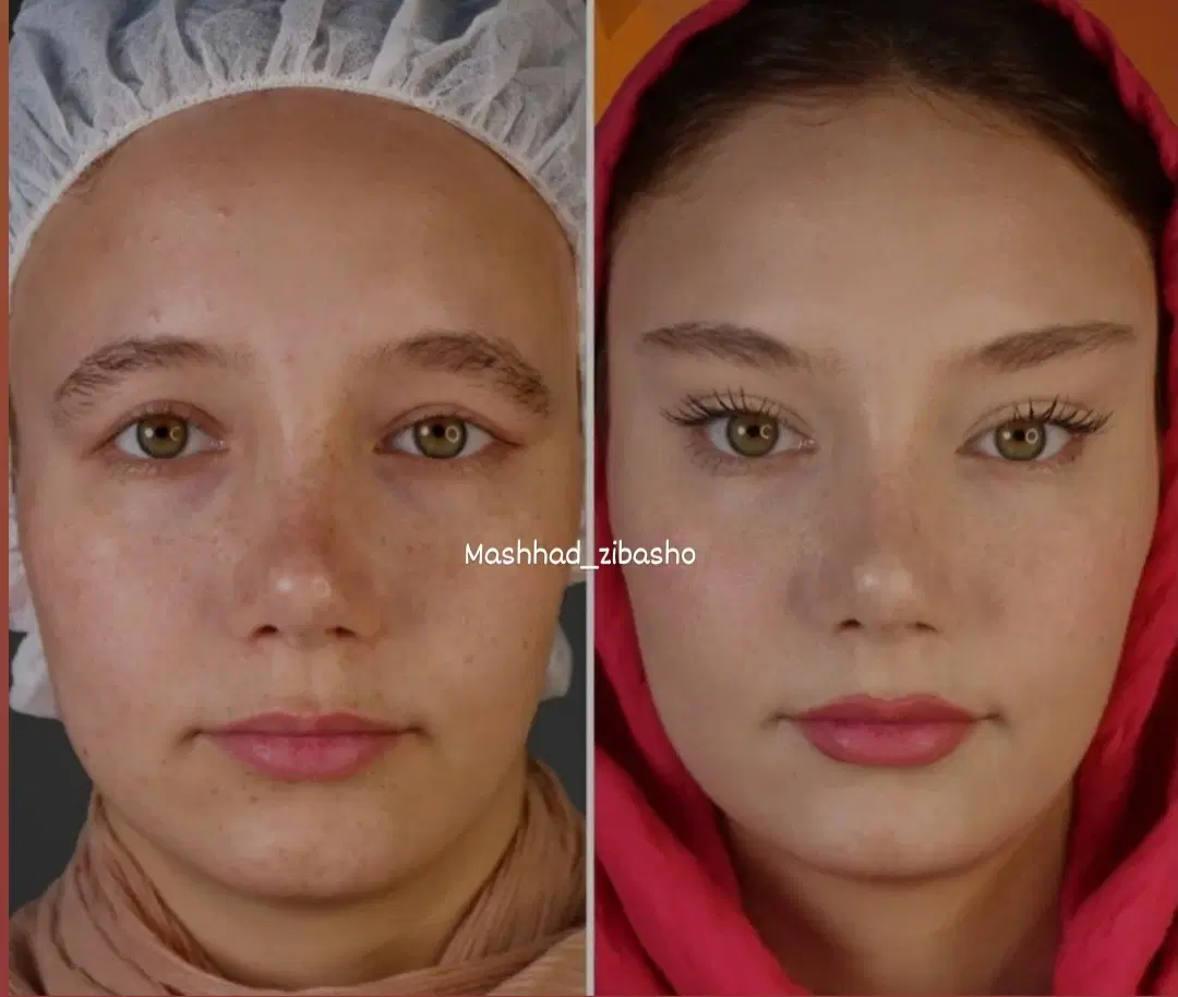 عمل بینی لیپو ساکشن ابدو غبغب بلفارو لیفت سانترال|خدمات زیبایی و سلامت|مشهد, احمدآباد|دیوار
