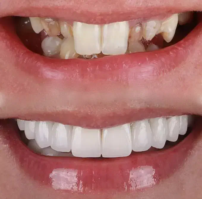 مهمترین عنصر زیبایی صورت ظاهر دندانهاست|خدمات آرایشگری و زیبایی|عنبرآباد, |دیوار